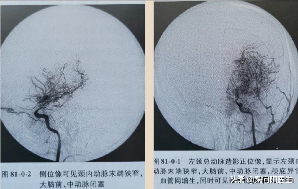 最新烟雾头调法研究及应用的探讨